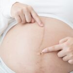 đường sọc nâu ở bụng xuất hiện khi nào
